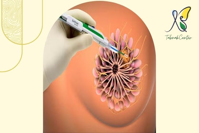 بعد از مارکرگذاری پستان چه مراقبت ‌هایی لازم است؟