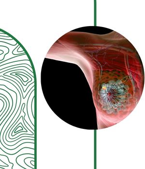 تخلیه کیست سینه چیست؟