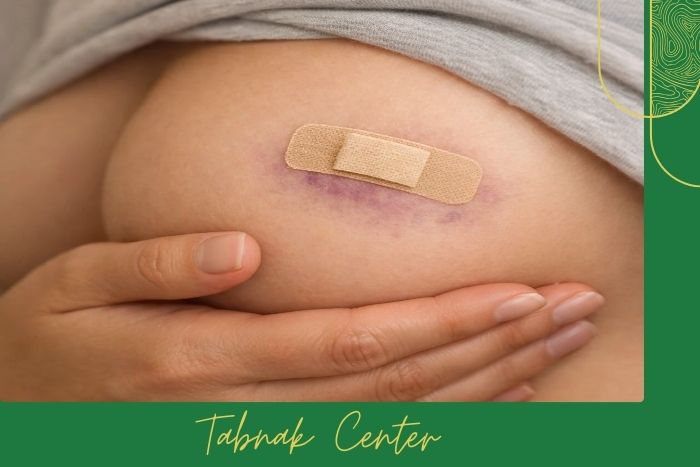 علائم طبیعی بعد از نشانه گذاری