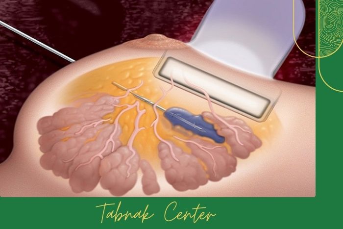 مزایا و محدودیت‌ های هر روش