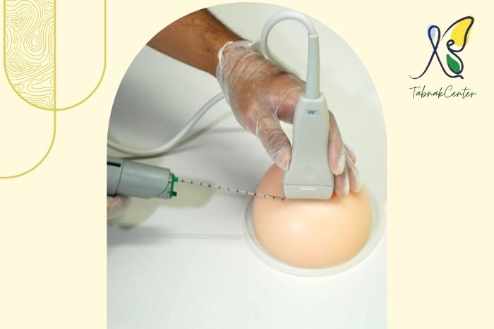 بعد از مارکرگذاری پستان چه مراقبت ‌هایی لازم است؟